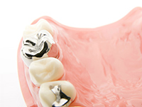 銀歯の危険性